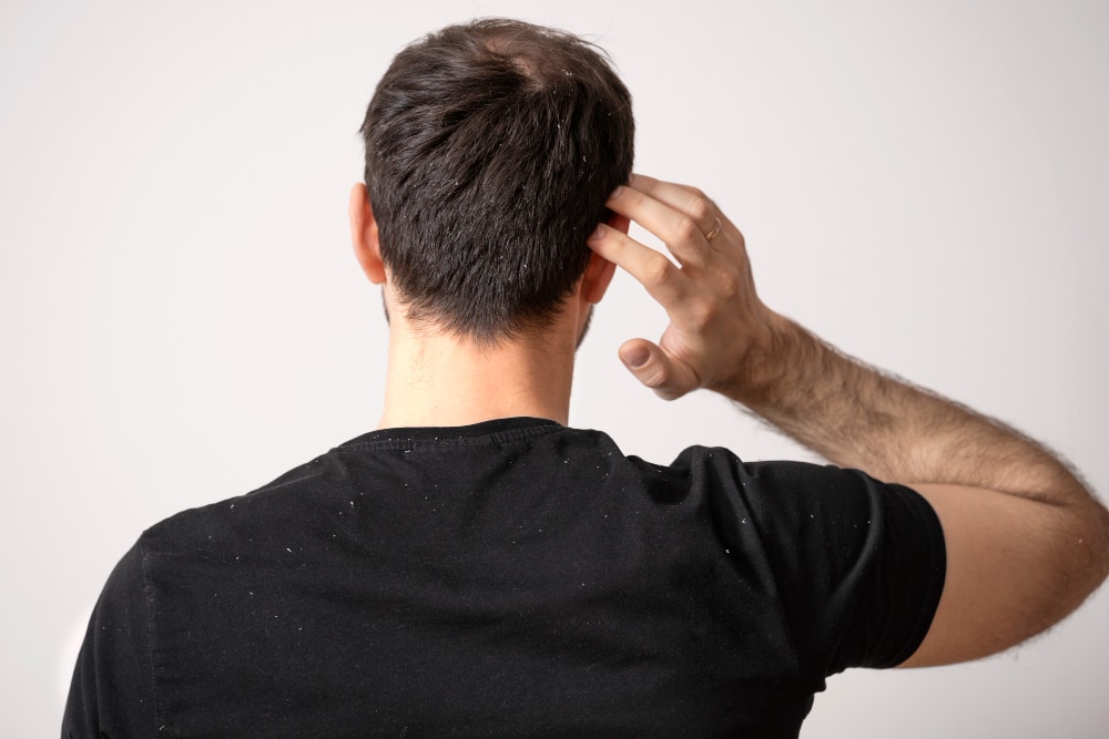 Can Dandruff Cause Hair Loss? Signs, Causes, and Easy Fixes