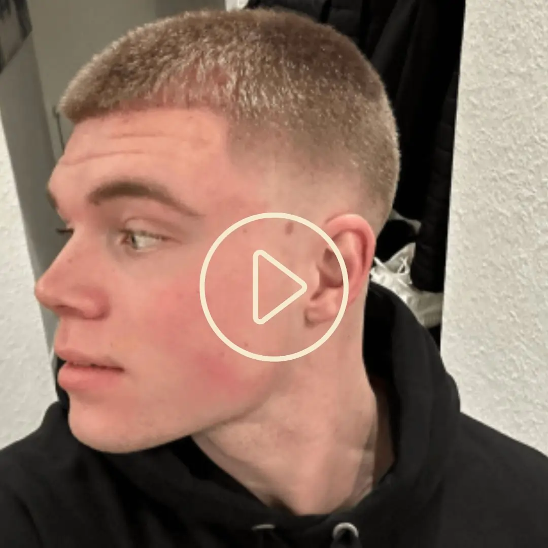 Copie de Hairtransplantation BeforeAfter + Testimonials(15)