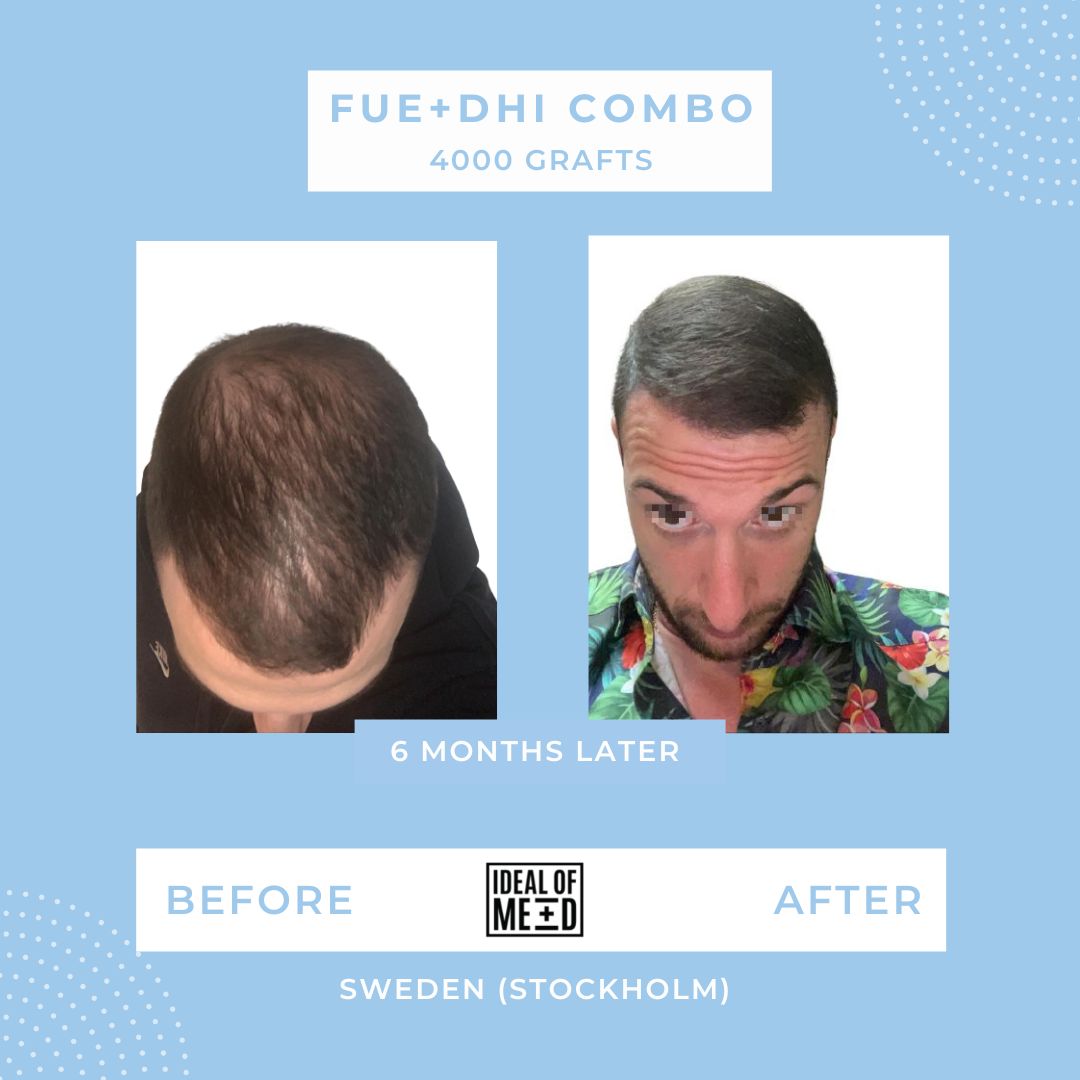 Hair Transplant Results After 6 Months of DHI and FUE Combination Hair Transplant