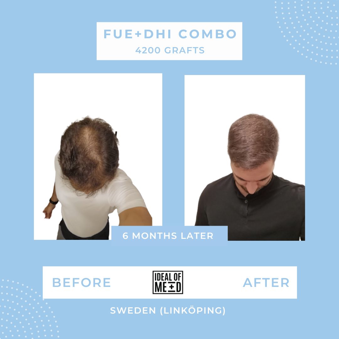 Hair Transplant Results After 6 Months with FUE/DHI Combination