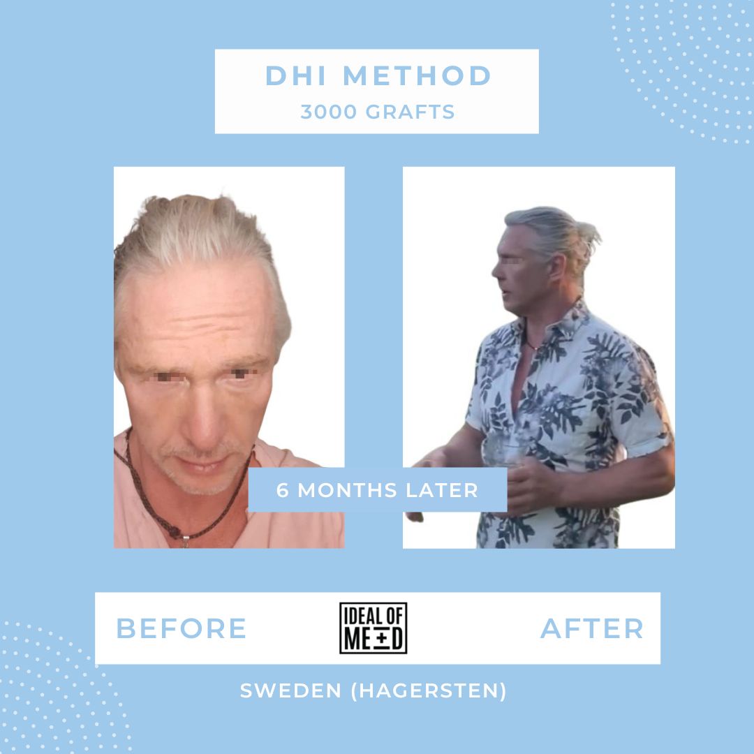 Hair Transplant Results After 6 Months with DHI