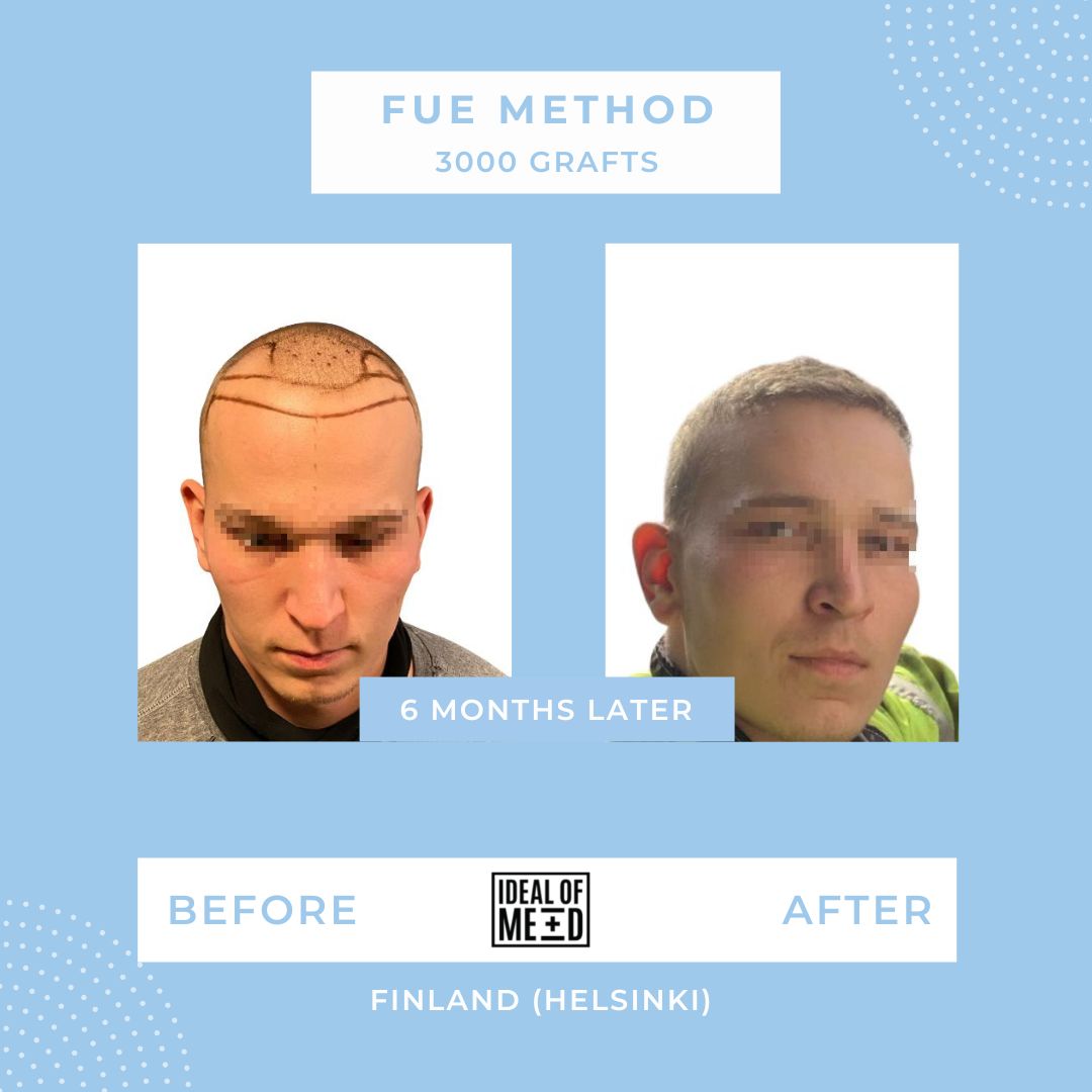 Hair Transplant Results After 6 Months with FUE