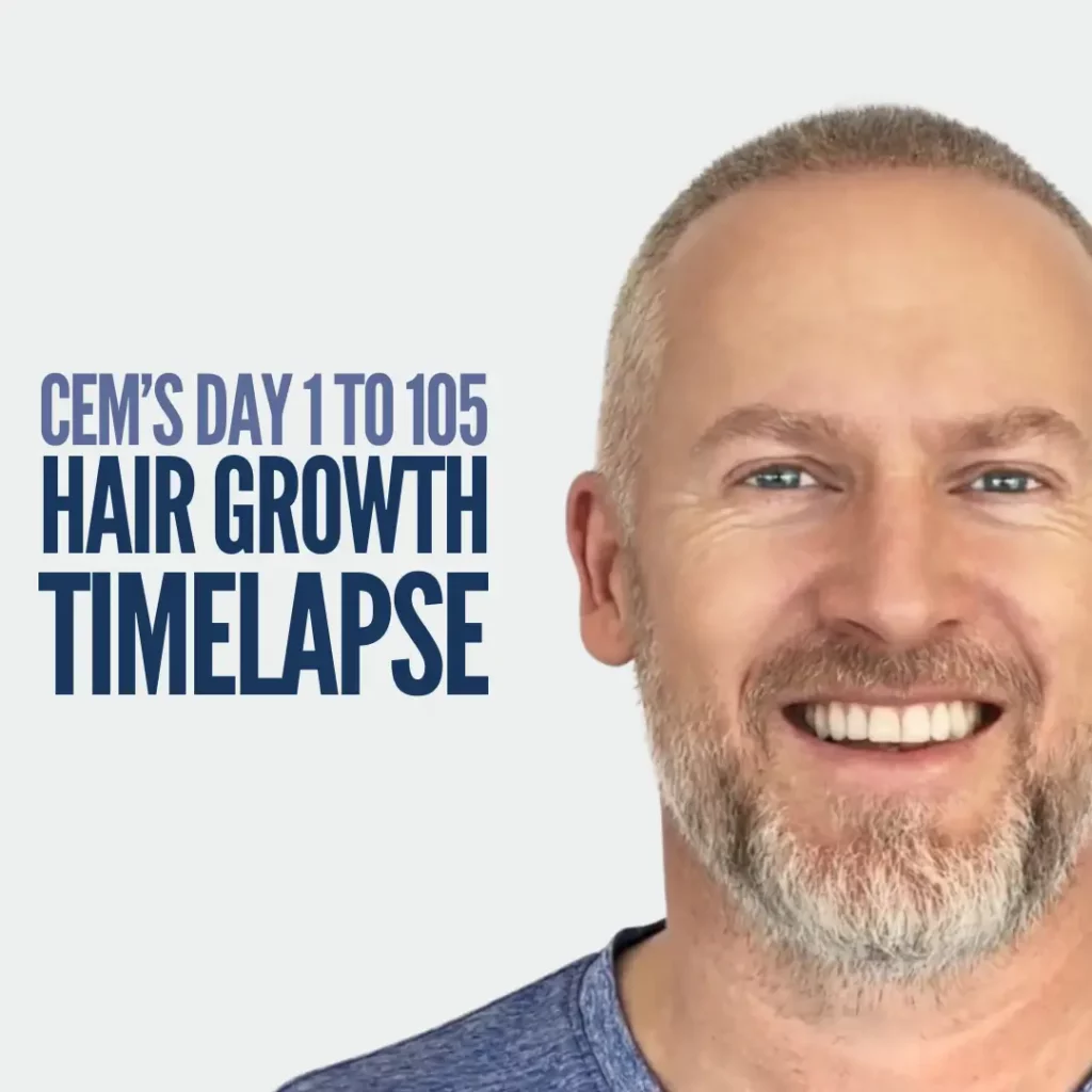 Hair Transplant Timelapse Cems 1-105 Journey