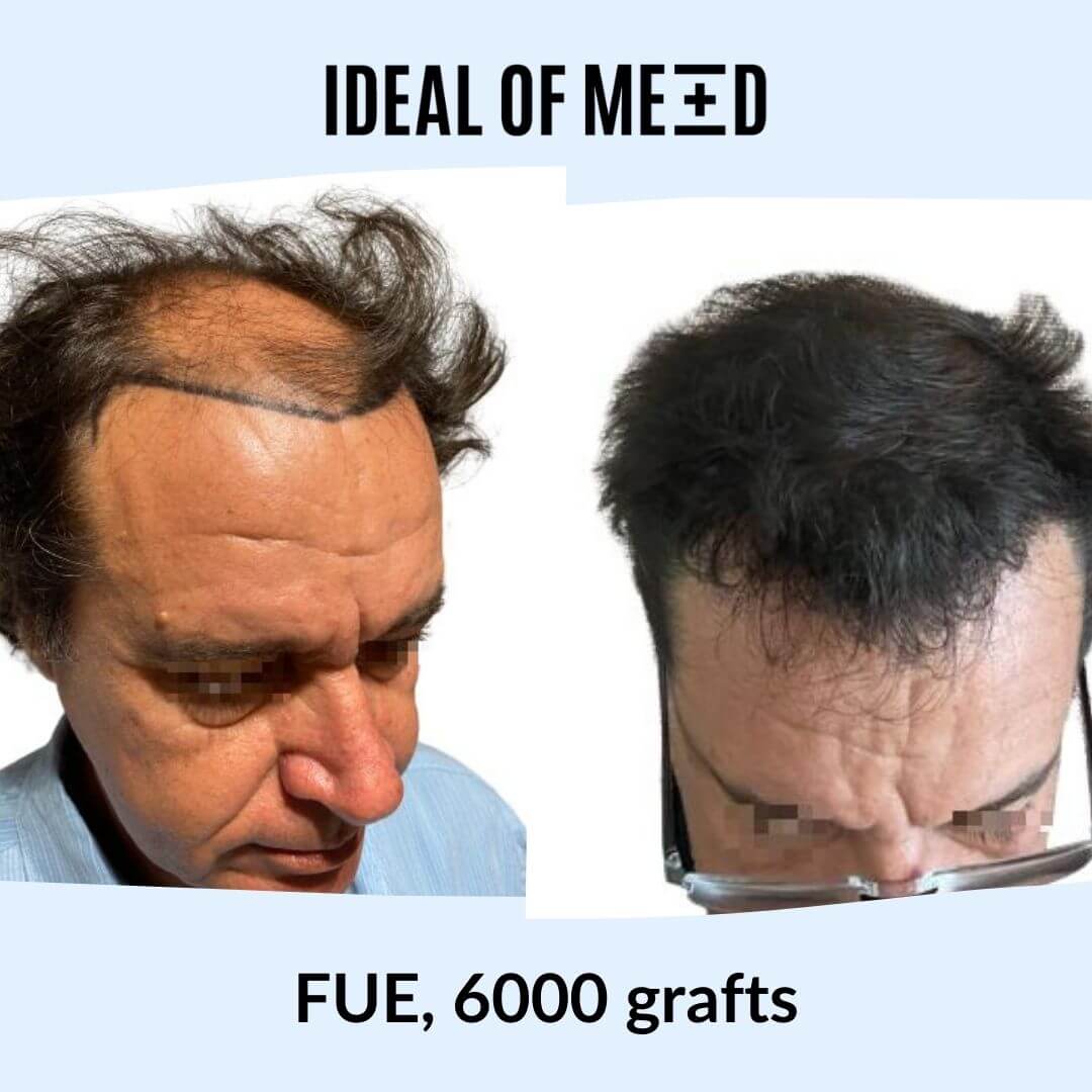 Hair transplant before and after picture idealofmed