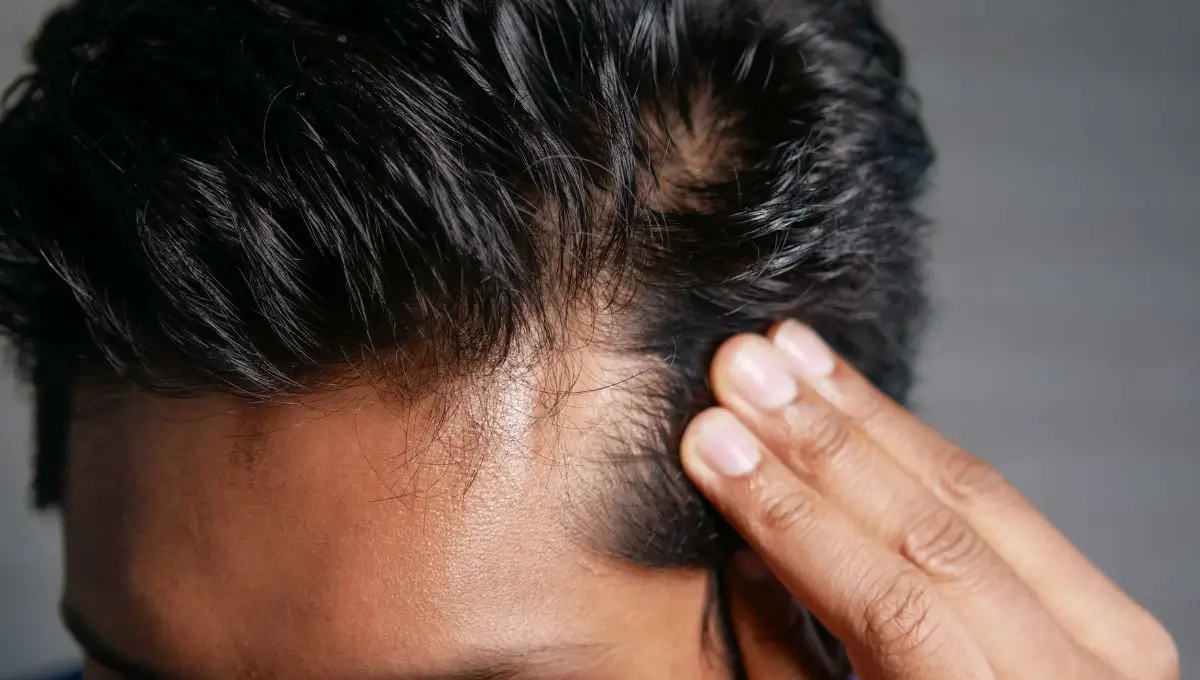 Hair transplant repair work: what we see when someone else did the transplant first