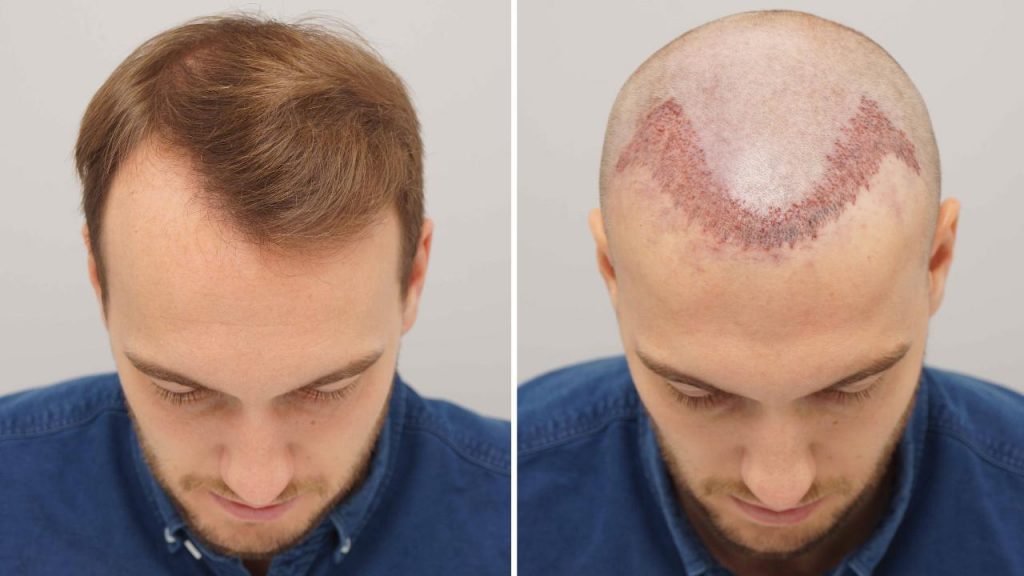 Hair Graft