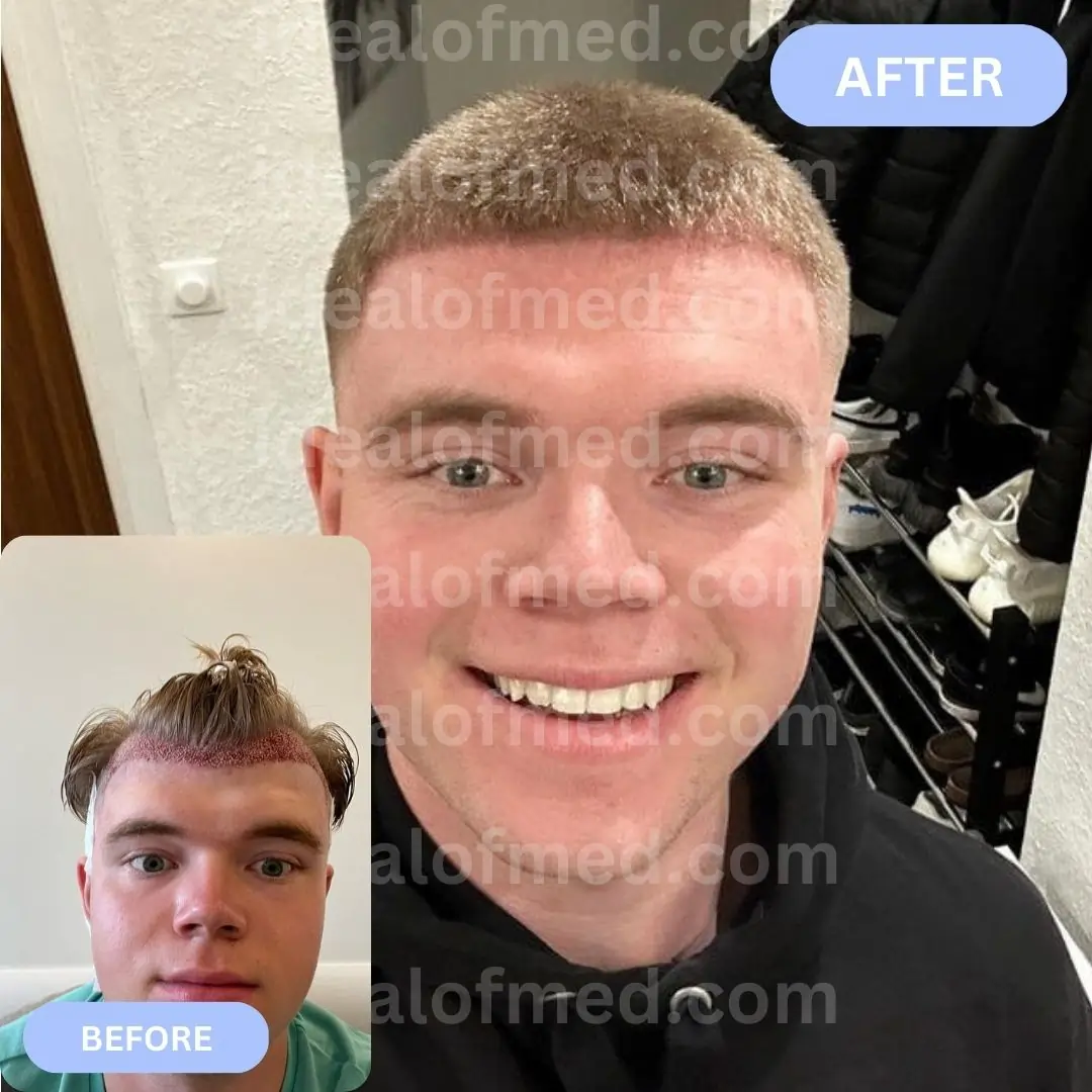 Hairtransplantation without shaving Before After