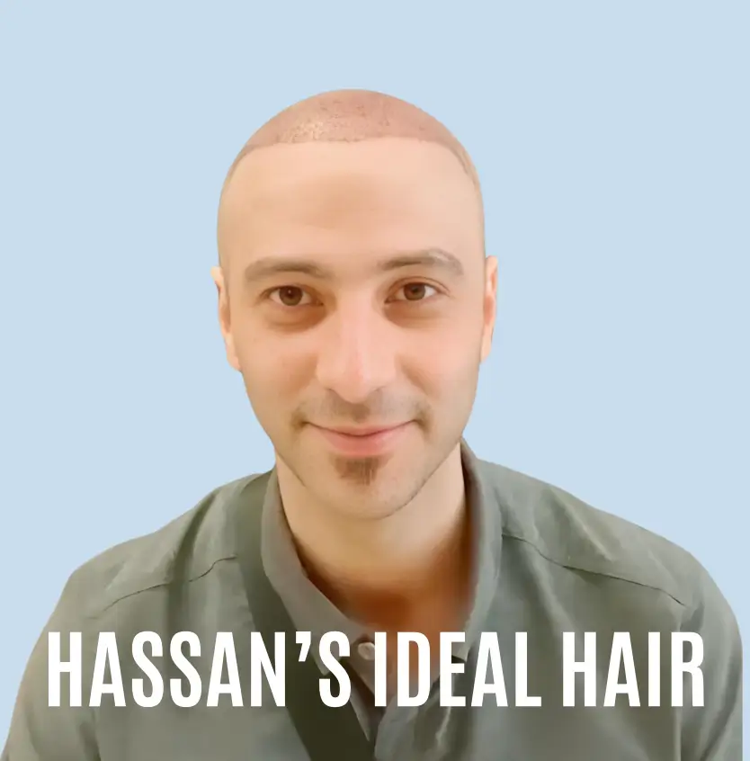 Hassan FUE Hair Transplant Testimonial 2025 IdealofMeD