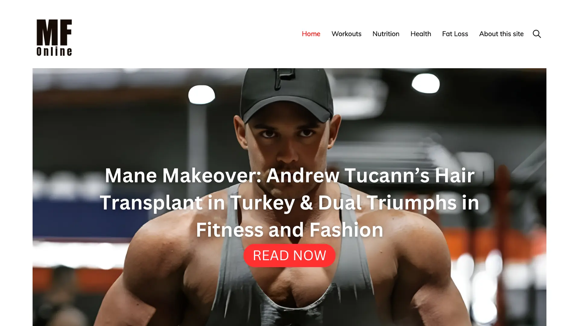 Andrew-Tucanns-hair-transplant-in-Turkey