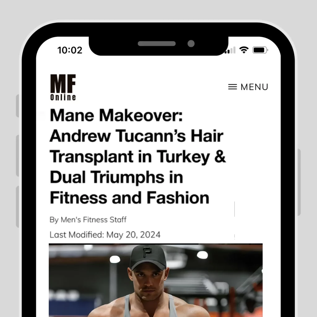 Andrew-Tucanns-hair-transplant-in-Turkey