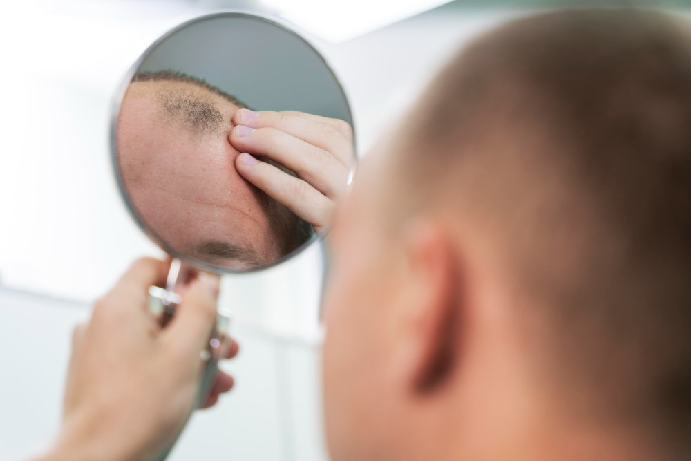 Types of Hair Loss: A Complete Guide to Causes and Solutions